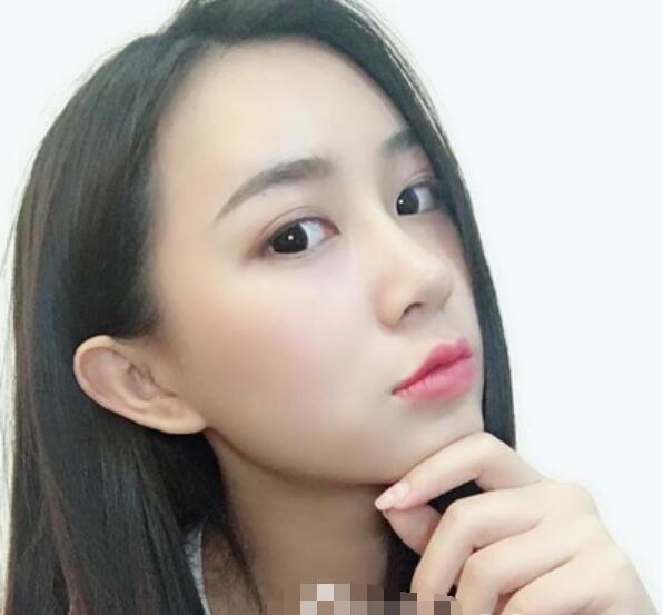 深圳鵬程整形劉冰做的鼻子術后兩個月