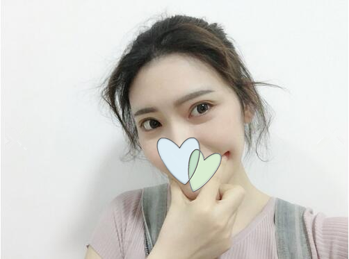 哈爾濱成美自體脂肪全臉填充案例術(shù)后三個月