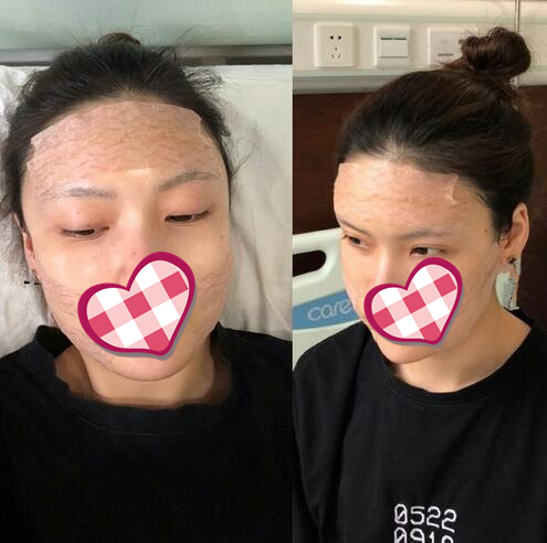 哈爾濱成美自體脂肪全臉填充案例術(shù)后第二天