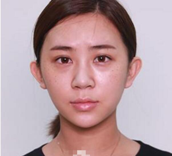深圳鵬程整形劉冰做的鼻子真絕了，跟我想象的一模一樣