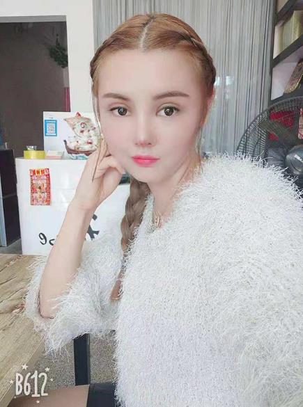 長(zhǎng)沙雅美眼鼻整形案例術(shù)后一個(gè)月效果