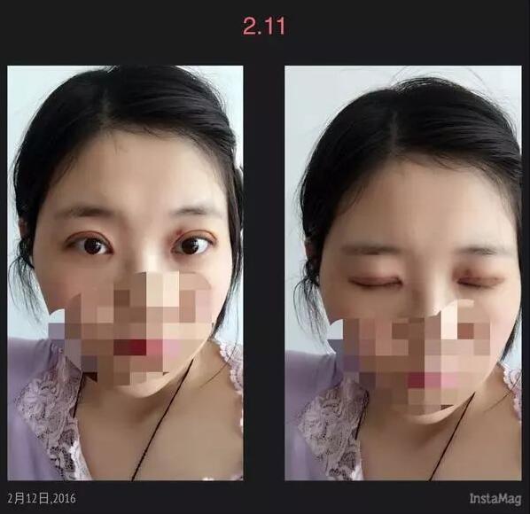 北京京民雙眼皮修復(fù)案例拆線后第二天