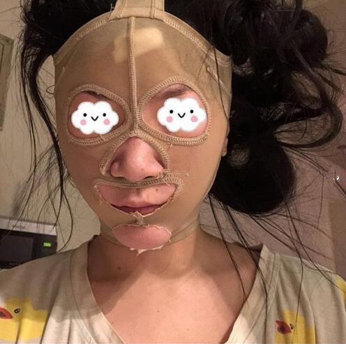 南京藝星整形趙海波面部吸脂術(shù)后一周