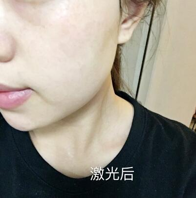 紹興維美整形激光祛斑兩個療程，皮膚像剝了殼的雞蛋