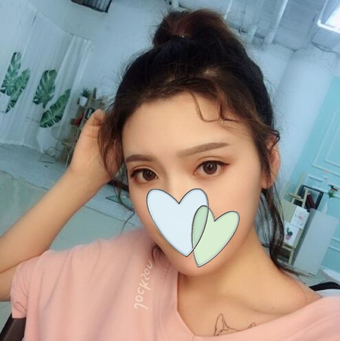 哈爾濱成美自體脂肪全臉填充案例一個月