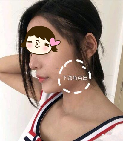 廣州美恩整形下頜角術(shù)后三個(gè)月反饋，真實(shí)效果看得見