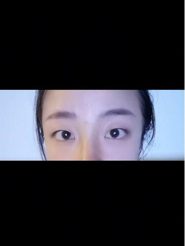 西安時(shí)光整形郭淑華雙眼皮案例分享，一個(gè)月就這么自然