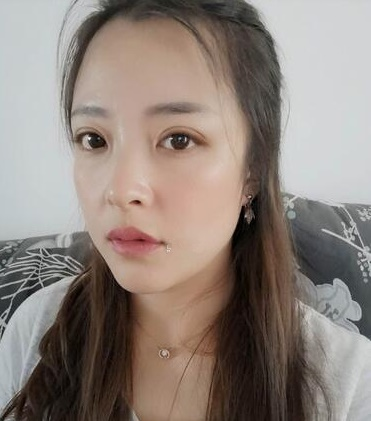 濟(jì)南韓式整形雙眼皮案例分享，單看術(shù)后半個(gè)月效果還以為手術(shù)失敗了