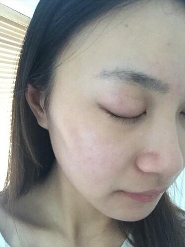 合肥艾雅整形紅藍光祛痘兩個療程結(jié)束后效果
