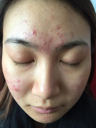 合肥艾雅整形紅藍(lán)光祛痘兩個(gè)療程效果，痘痘都消失了