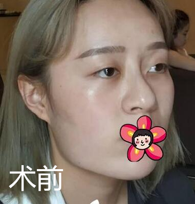 北京基礎(chǔ)美下頜角整形案例效果分享，黃大勇果然名不虛傳