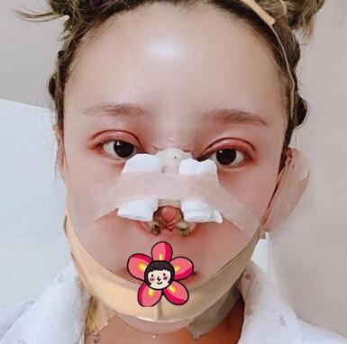 北京基礎美下頜角整形術后十天