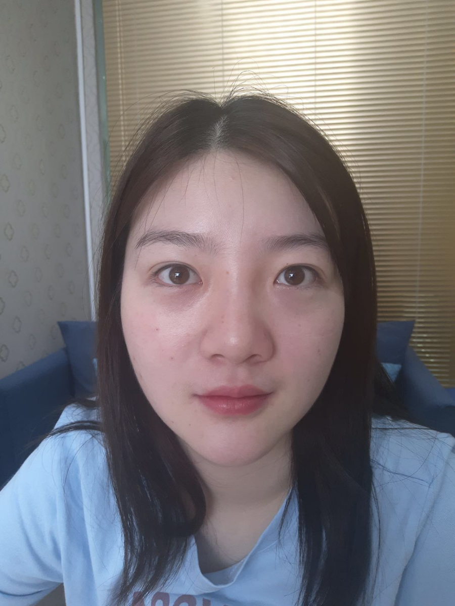 北京圣嘉榮二次鼻修復(fù)案例分享，做整形一定不要去莆田系醫(yī)院