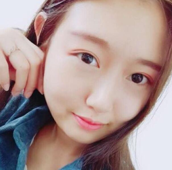 武漢伽美整形劉翼面部吸脂案例分享