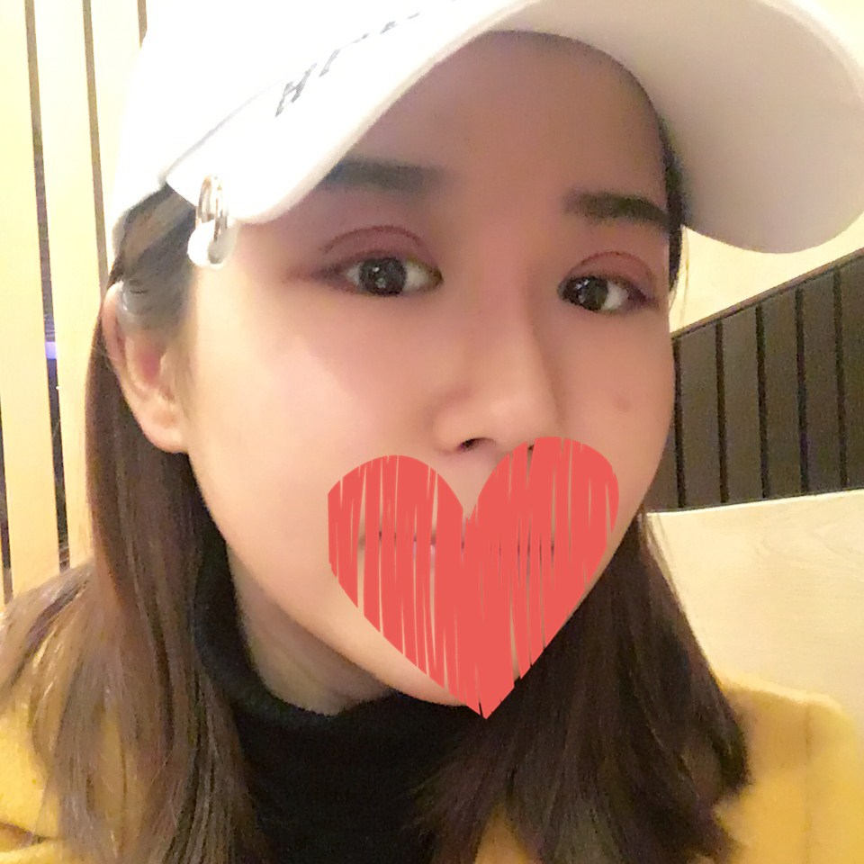 滄州中妤整形張明切開雙眼皮拆線后三天效果