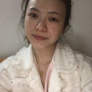 邯鄲佑熙整形孫堅激光祛斑前