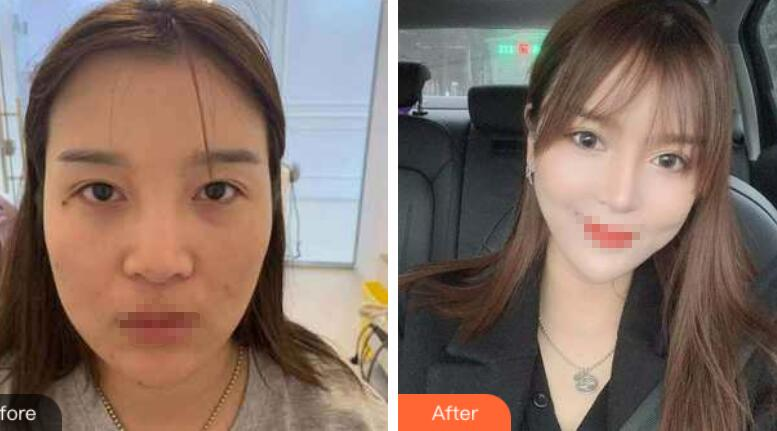 蘭州潤(rùn)妍整形鼻綜合案例分享