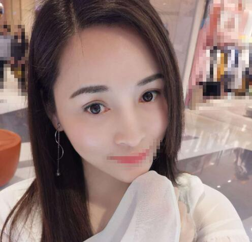 赤峰現(xiàn)代婦產(chǎn)醫(yī)院醫(yī)療美容科袁俊龍雙眼皮修復案例分享