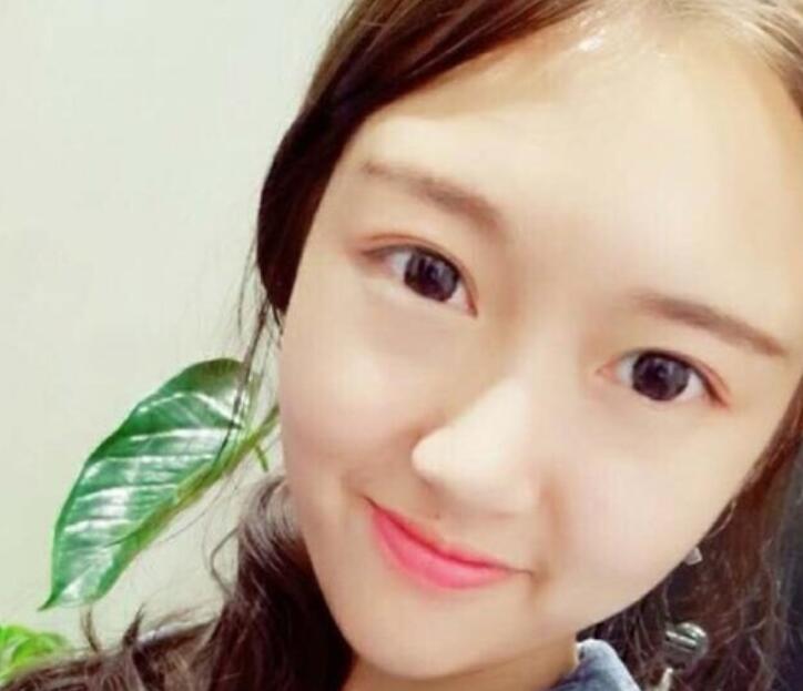 武漢伽美整形劉翼面部吸脂術(shù)后一個月效果