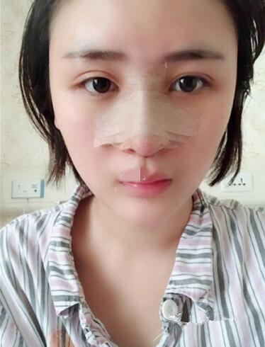 濟(jì)南鵬愛(ài)整形醫(yī)院怎么樣？濟(jì)南鵬愛(ài)王飏隆鼻案例分享