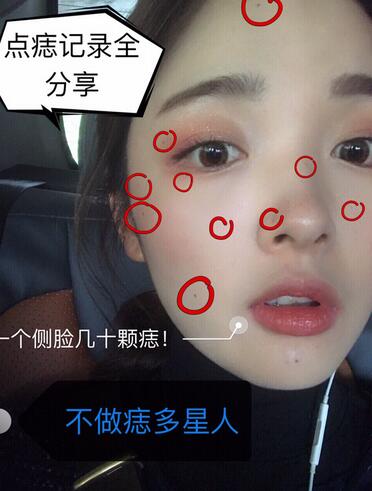 做激光點痣之前的效果