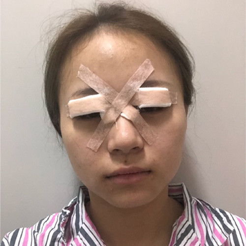 杭州靜港林忠泵埋線雙眼皮案例1-7天效果圖分享，讓你的眼睛魅力四射