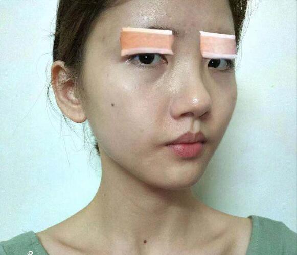 做切開雙眼皮手術之前的我
