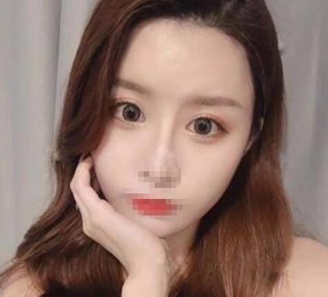 完全恢復(fù)后的雙眼皮效果