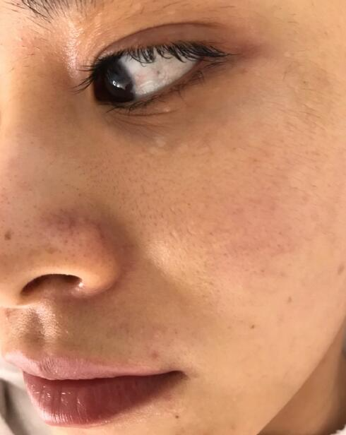 福州愛思特比華利整形林秋蓉醫(yī)生做光子嫩膚過程體驗(yàn)！皮膚Q彈