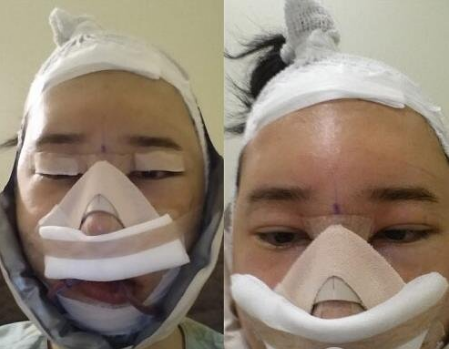 重慶三峽中心醫(yī)院頜面外科張宇下頜角案例手術(shù)效果對比圖