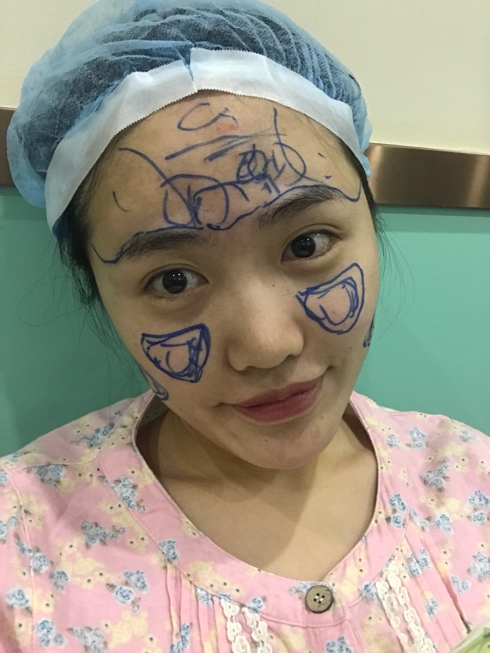 北京星美李寧輝進口膨體隆鼻案例