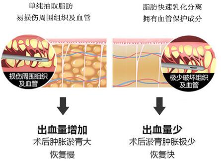 環(huán)形吸脂減肥手術原理介紹：