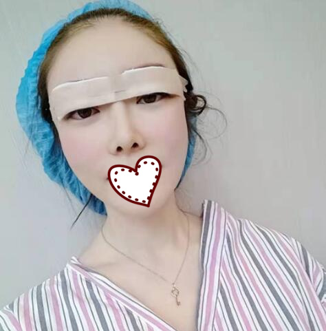 北京亞奇龍醫(yī)療整形醫(yī)生陳煥然雙眼皮案例效果對比圖