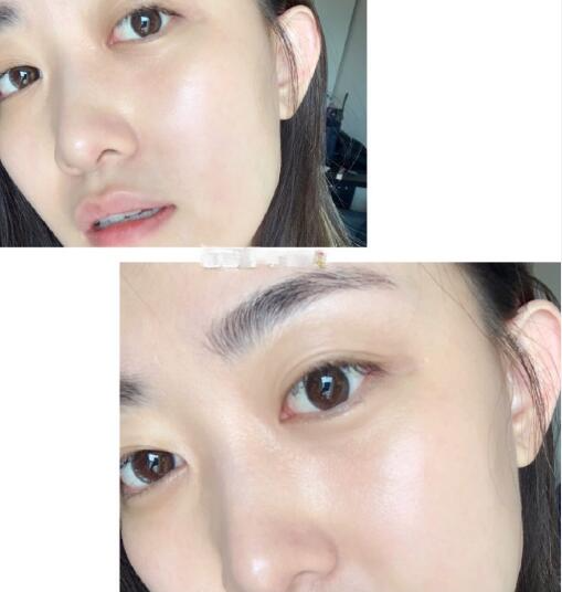 贛州韓美整形吳彩霞果酸換膚效果對比圖