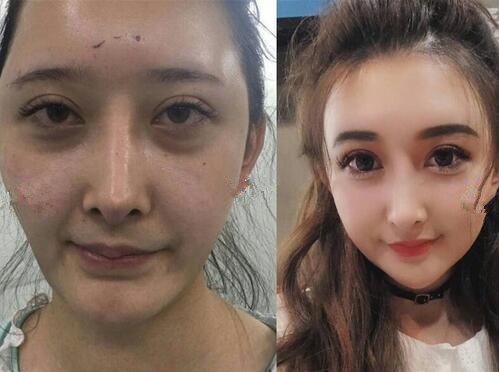 面部脂肪填充，整個人都發(fā)生了很大變化。
