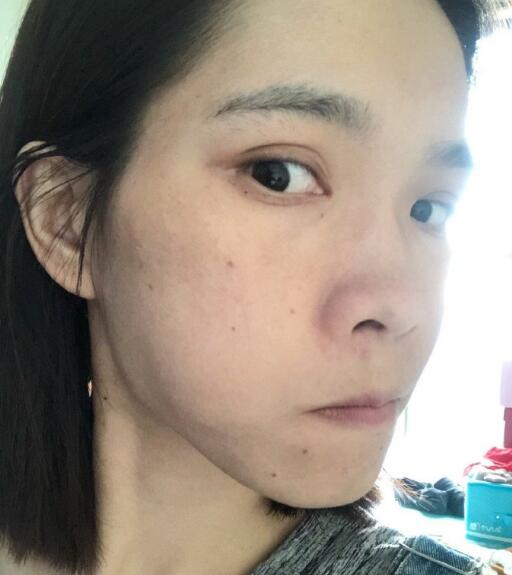 北京藝星整形專家廖苑利做光子嫩膚怎么樣？廖苑利光子嫩膚案例效果展示