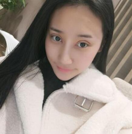 北京葉子整形美容醫(yī)院做焊接雙眼皮效果怎么樣？北京葉子整形焊接雙眼皮案例展示