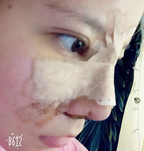 嘉興曙光美容醫(yī)院整形專家王良發(fā)做假體隆鼻怎么樣？王良發(fā)假體隆鼻案例