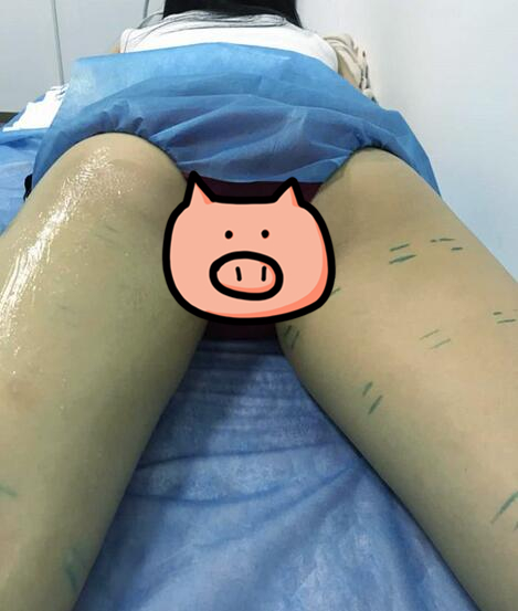 準備進行大腿吸脂手術(shù)