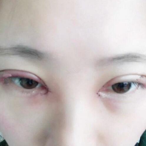 眼綜合整形手術后
