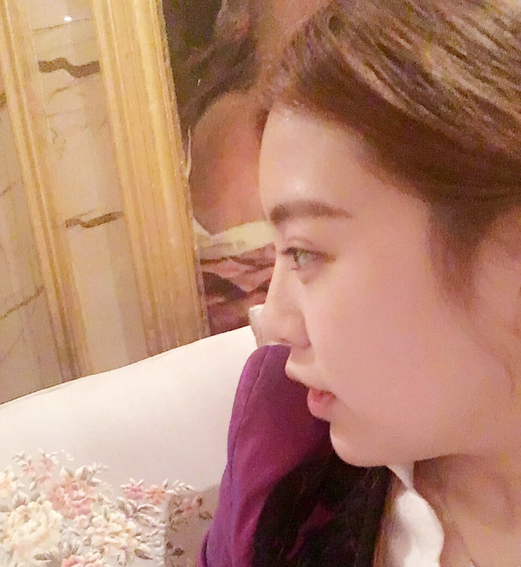 黑龍江藝星醫(yī)生巫文云做鼻部修復(fù)怎么樣，巫文云玻鼻部修復(fù)案例分享