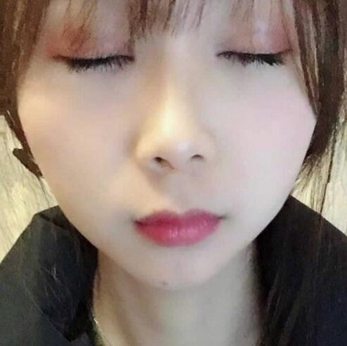 眼綜合整形手術半個月。