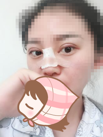 術后60天效果。