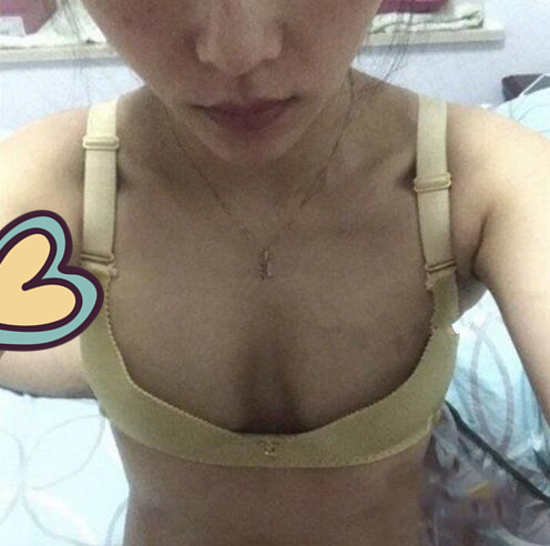廣州駐顏光醫(yī)療美容診所整形專家劉培做復(fù)合隆胸技術(shù)怎么樣？附案例