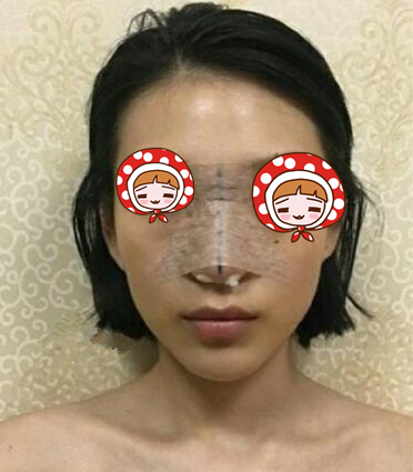 北京京韓醫(yī)療硅膠隆鼻案例