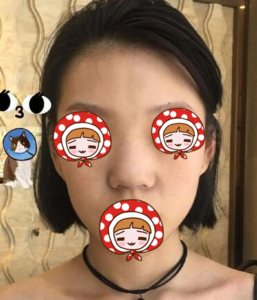 北京京韓醫(yī)療美容診所做硅膠隆鼻效果怎么樣？北京京韓醫(yī)療硅膠隆鼻案例