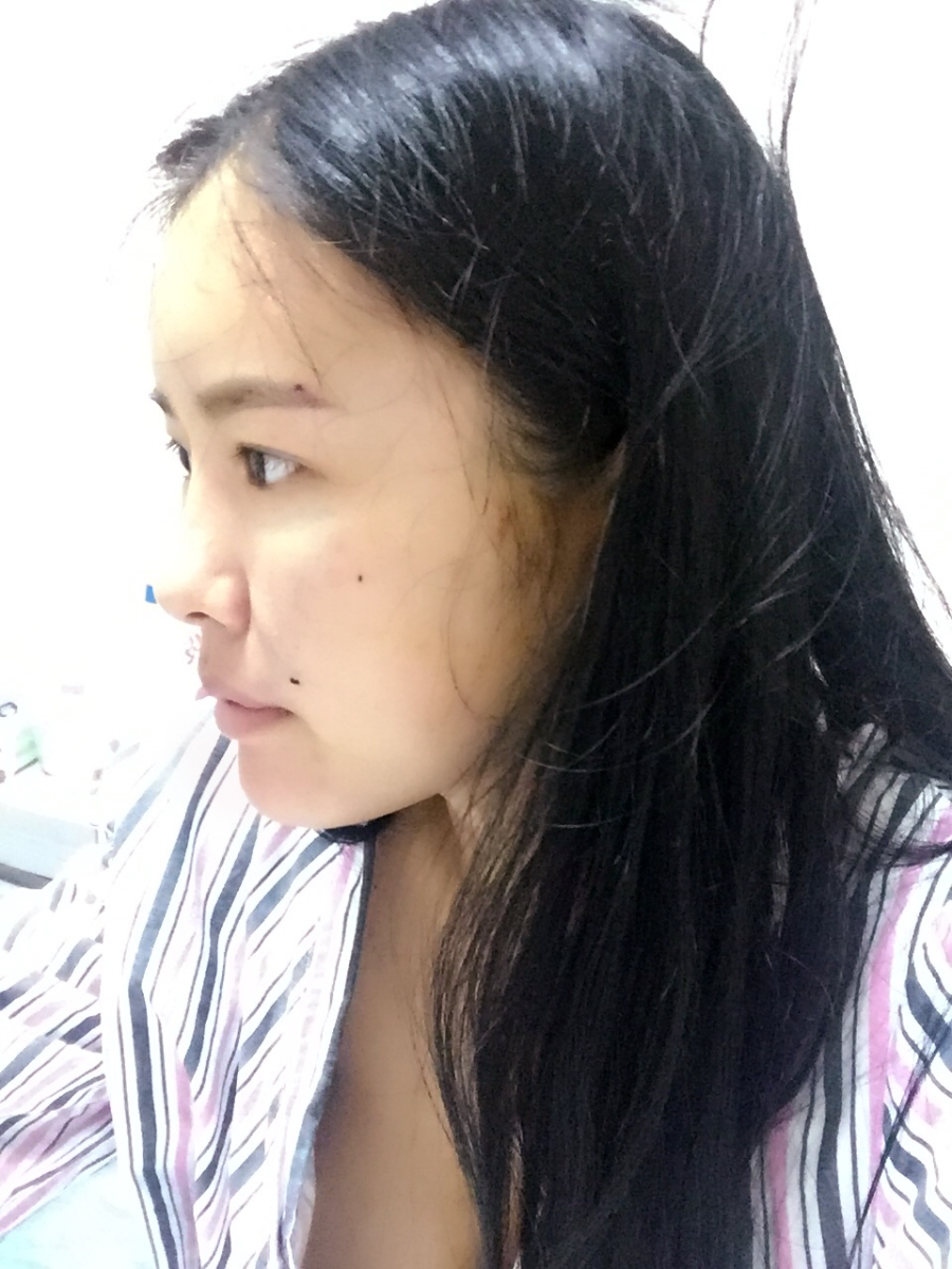 西安莎曼妃醫(yī)療美容醫(yī)院醫(yī)生樸俊做自體脂肪豐太陽穴效果怎么樣？