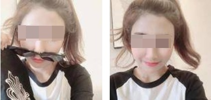 昆明麗都整形醫(yī)生孟春麗做面部自體脂肪填充效果怎么樣？