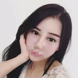 東莞維多利亞做硅膠隆鼻怎么樣？整形醫(yī)生李剛硅膠隆鼻案例分享