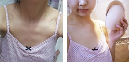 沈陽(yáng)杏林整形美容醫(yī)院崔昌墉醫(yī)生做假體隆胸技術(shù)怎么樣？附案例